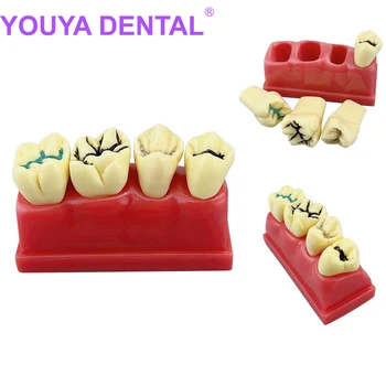 Модель стоматологического исследования 4 раза, лечение ям и трещин, герметизация зубов, Модель кариеса, Съемные зубы, Модель зубов, Стоматология Тоже
